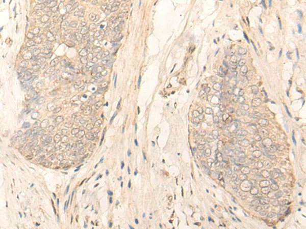 Immunohistochemistry of paraffin-embedded Human esophagus cancer tissue  using GK5 Polyclonal Antibody at dilution of 1:35(?200)