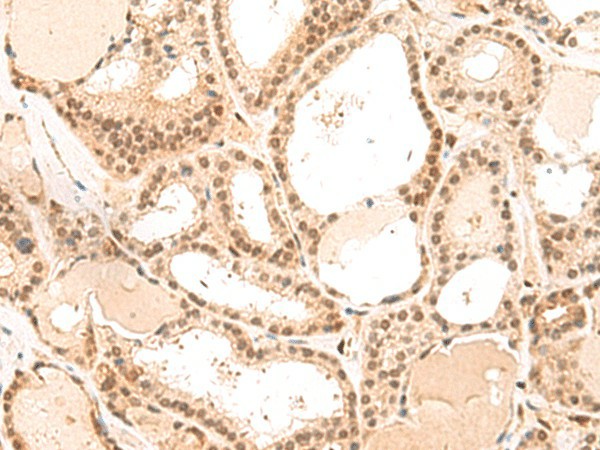 Immunohistochemistry of paraffin-embedded Human thyroid cancer tissue  using MKX Polyclonal Antibody at dilution of 1:50(?200)