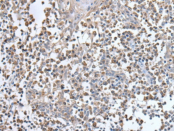 Immunohistochemistry of paraffin-embedded Human tonsil tissue  using UBN1 Polyclonal Antibody at dilution of 1:130(?200)