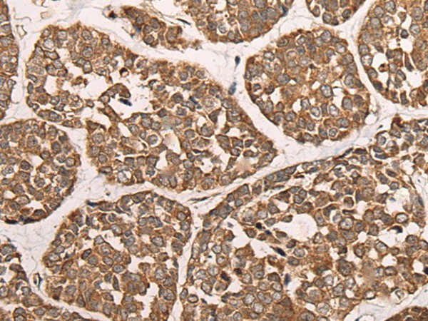 Immunohistochemistry of paraffin-embedded Human esophagus cancer tissue  using CAD Polyclonal Antibody at dilution of 1:50(?200)