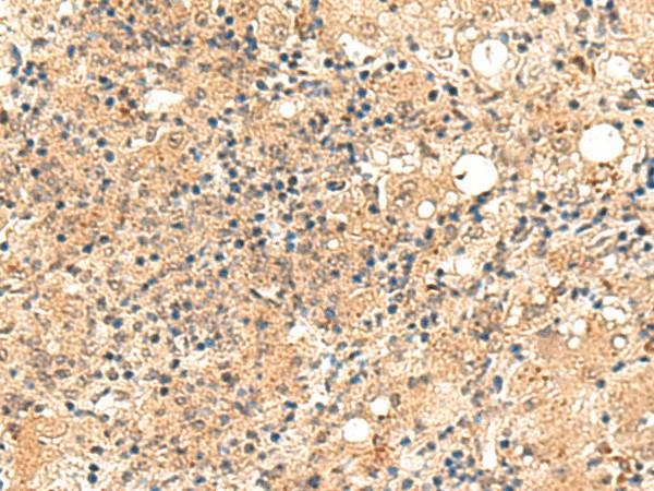 Immunohistochemistry of paraffin-embedded Human esophagus cancer tissue  using ZFYVE27 Polyclonal Antibody at dilution of 1:50(?200)