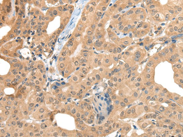 Immunohistochemistry of paraffin-embedded Human thyroid cancer tissue  using CA7 Polyclonal Antibody at dilution of 1:50(?200)