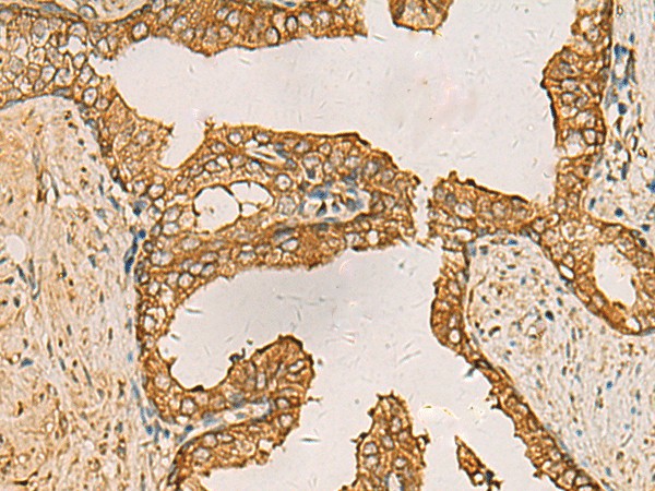 Immunohistochemistry of paraffin-embedded Human prost ate cancer tissue  using AIMP1 Polyclonal Antibody at dilution of 1:55(?200)