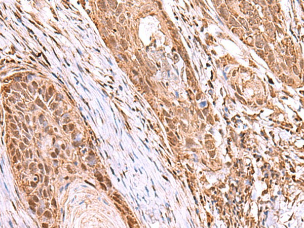 Immunohistochemistry of paraffin-embedded Human esophagus cancer tissue  using RCOR3 Polyclonal Antibody at dilution of 1:55(?200)