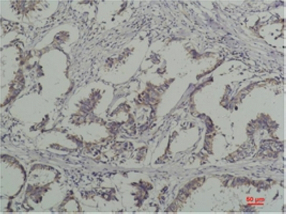 Immunohistochemistry of paraffin-embedded Human breast carcinoma tissue with Phosphotyrosine Monoclonal Antibody at dilution of 1:200