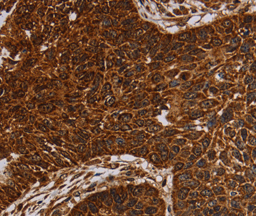 Immunohistochemistry of paraffin-embedded Human lung cancer tissue using NDUFAB1 Polyclonal Antibody at dilution 1:50