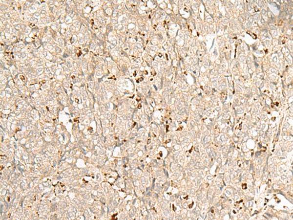 Immunohistochemistry of paraffin-embedded Human ovarian cancer tissue  using NUP210 Polyclonal Antibody at dilution of 1:30(?200)