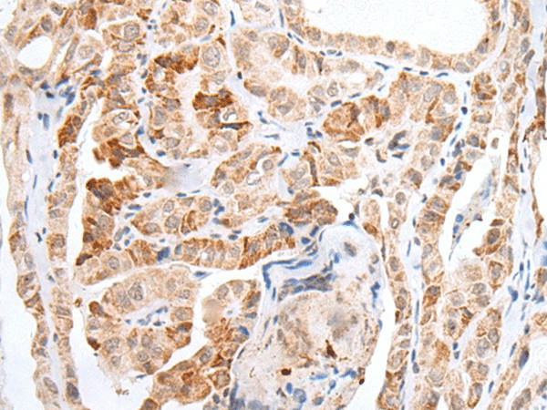 Immunohistochemistry of paraffin-embedded Human thyroid cancer tissue  using HOXC11 Polyclonal Antibody at dilution of 1:25(?200)