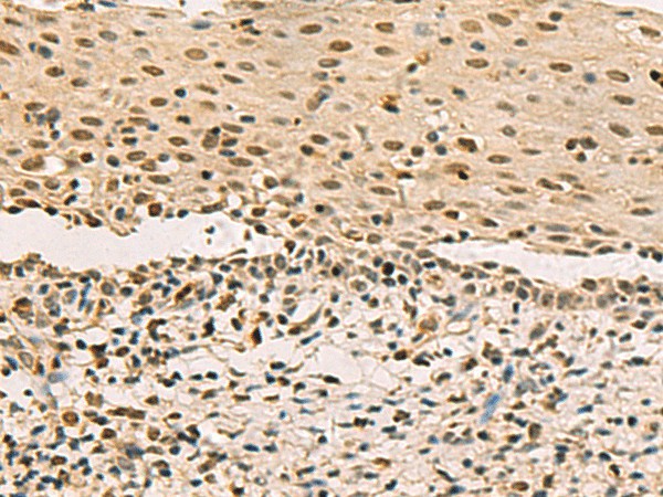 Immunohistochemistry of paraffin-embedded Human cervical cancer tissue  using LRIF1 Polyclonal Antibody at dilution of 1:70(?200)