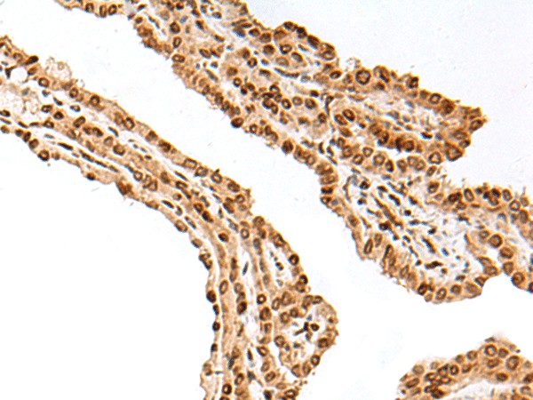 Immunohistochemistry of paraffin-embedded Human thyroid cancer tissue  using FANCB Polyclonal Antibody at dilution of 1:25(?200)