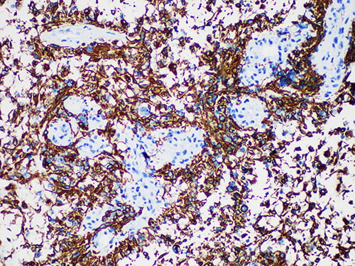 Immunohistochemistry of paraffinembedded Human glioma tissue with Glial Fibrillary Acidic Protein(GFAP) Monoclonal Antibody(Antigen repaired by EDTA).