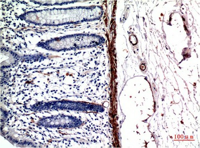 Immunohistochemistry of paraffin-embedded Human colon carcinoma tissue using ACTA1 Monoclonal Antibody at dilution of 1:200.