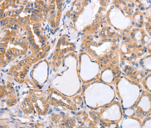 Immunohistochemistry of paraffin-embedded Human thyroid cancer tissue using TGFA Polyclonal Antibody at dilution 1:60