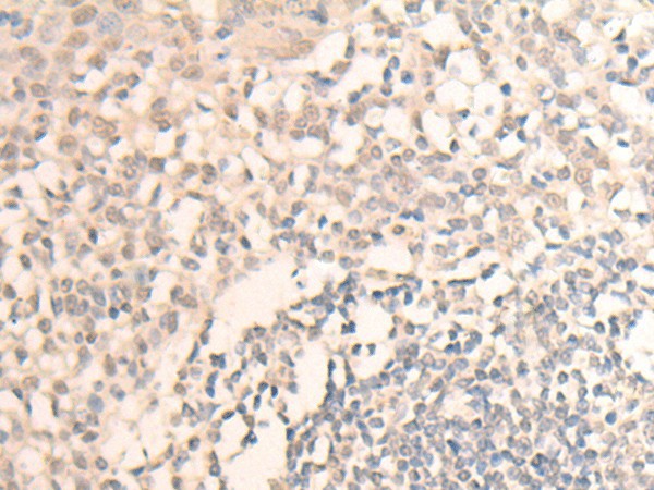 Immunohistochemistry of paraffin-embedded Human tonsil tissue  using MLLT6 Polyclonal Antibody at dilution of 1:40(?200)