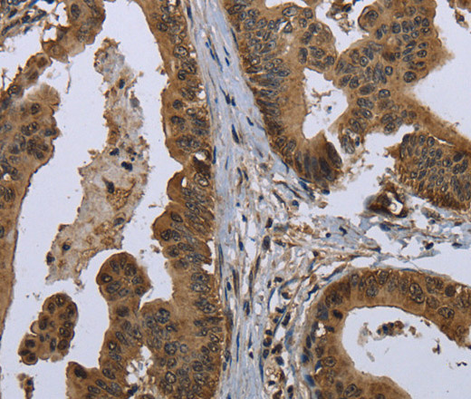 Immunohistochemistry of paraffin-embedded Human gastric cancer using GOLGA2 Polyclonal Antibody at dilution of 1:60