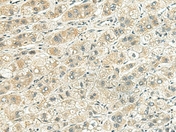 Immunohistochemistry of paraffin-embedded Human liver cancer tissue  using RHBDL2 Polyclonal Antibody at dilution of 1:140(?200)