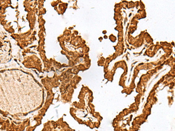 Immunohistochemistry of paraffin-embedded Human thyroid cancer tissue  using FAM50A Polyclonal Antibody at dilution of 1:25(?200)