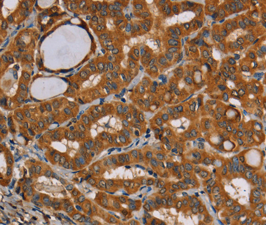 Immunohistochemistry of paraffin-embedded Human thyroid cancer tissue using CENPU Polyclonal Antibody at dilution 1:30