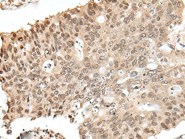 Immunohistochemistry of paraffin-embedded Human colorectal cancer tissue  using ZNF410 Polyclonal Antibody at dilution of 1:40(?200)