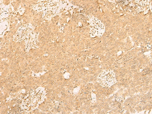 Immunohistochemistry of paraffin-embedded Human ovarian cancer tissue  using GSG1L Polyclonal Antibody at dilution of 1:50(?200)