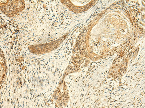 Immunohistochemistry of paraffin-embedded Human esophagus cancer tissue  using ARL4D Polyclonal Antibody at dilution of 1:50(?200)