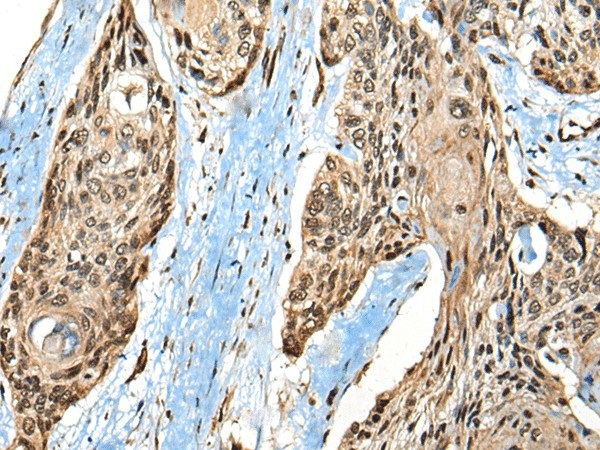 Immunohistochemistry of paraffin-embedded Human esophagus cancer tissue  using CASK Polyclonal Antibody at dilution of 1:65(?200)