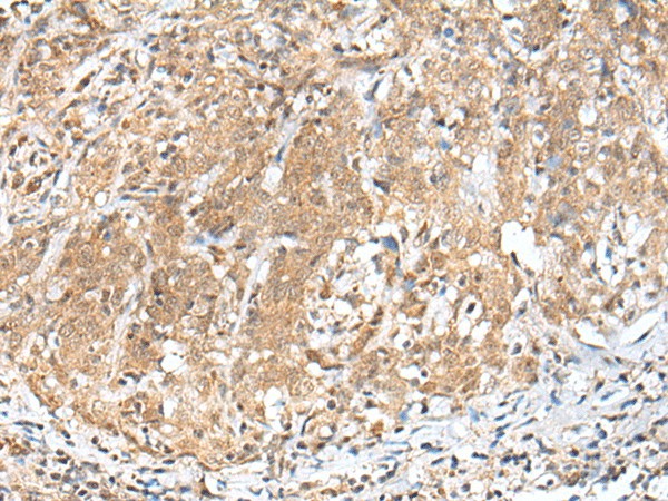 Immunohistochemistry of paraffin-embedded Human cervical cancer tissue  using PEG3 Polyclonal Antibody at dilution of 1:45(?200)