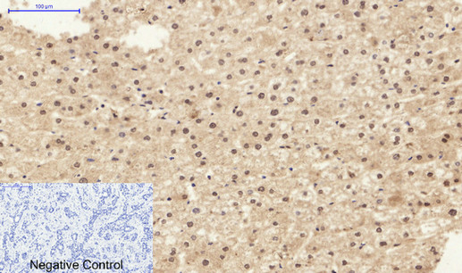 Immunohistochemistry of paraffin-embedded Human liver cancer tissue using Stat1 Polyclonal Antibody at dilution of 1:200.