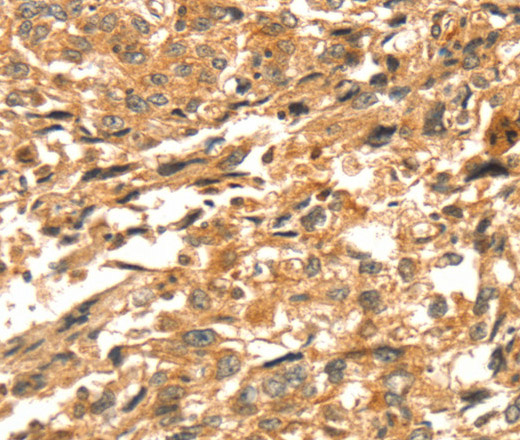 Immunohistochemistry of paraffin-embedded Human esophagus cancer tissue using DIRAS1 Polyclonal Antibody at dilution 1:52