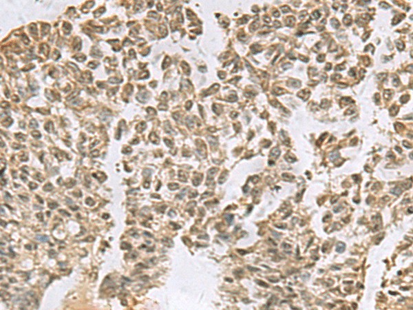 Immunohistochemistry of paraffin-embedded Human ovarian cancer tissue  using ELOC Polyclonal Antibody at dilution of 1:55(?200)