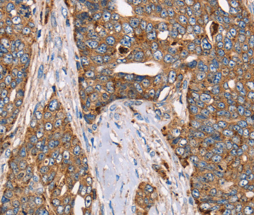 Immunohistochemistry of paraffin-embedded Human cervical cancer using FUCA1 Polyclonal Antibody at dilution of 1:30