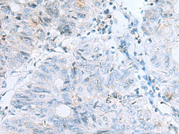 Immunohistochemistry of paraffin-embedded Human colorectal cancer tissue  using POMC Polyclonal Antibody at dilution of 1:35(?200)