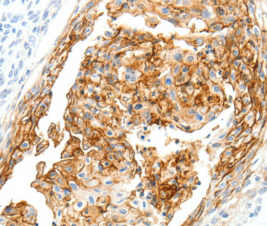 Immunohistochemistry of paraffin-embedded Human cervical cancer tissue using SEMA3D Polyclonal Antibody at dilution 1:40