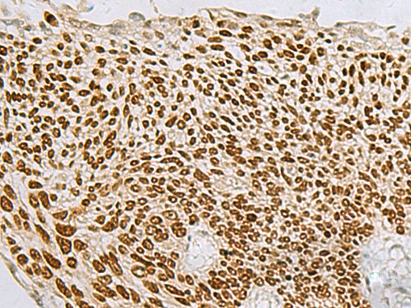 Immunohistochemistry of paraffin-embedded Human lung cancer tissue  using TP63 Polyclonal Antibody at dilution of 1:65(?200)