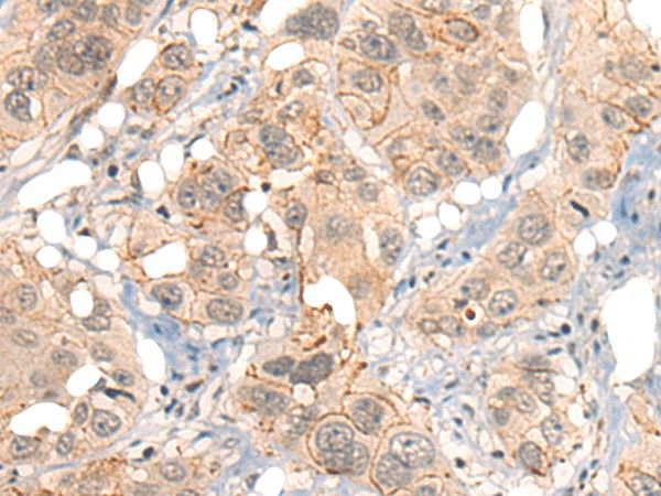 Immunohistochemistry of paraffin-embedded Human esophagus cancer tissue  using GPR55 Polyclonal Antibody at dilution of 1:40(?200)