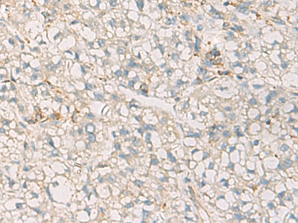 Immunohistochemistry of paraffin-embedded Human liver cancer tissue  using SUSD3 Polyclonal Antibody at dilution of 1:85(?200)