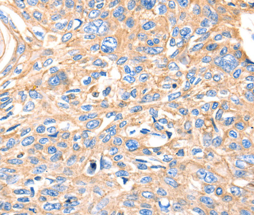 Immunohistochemistry of paraffin-embedded Human esophagus cancer using MVP Polyclonal Antibody at dilution of 1:30