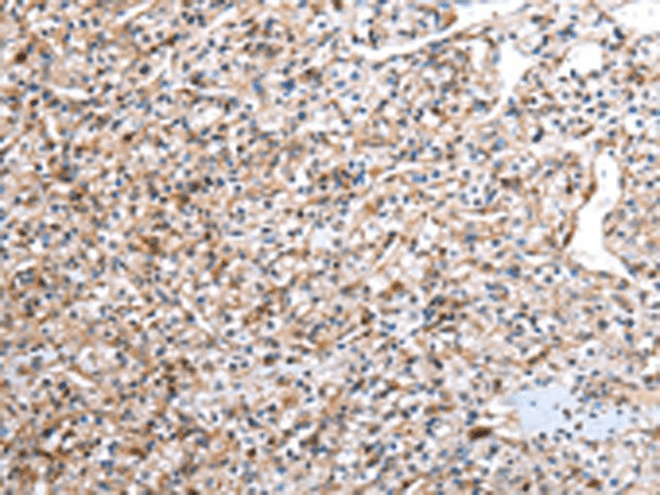 Immunohistochemistry of paraffin-embedded Human prost ate cancer tissue  using DCAF7 Polyclonal Antibody at dilution of 1:30(?200)