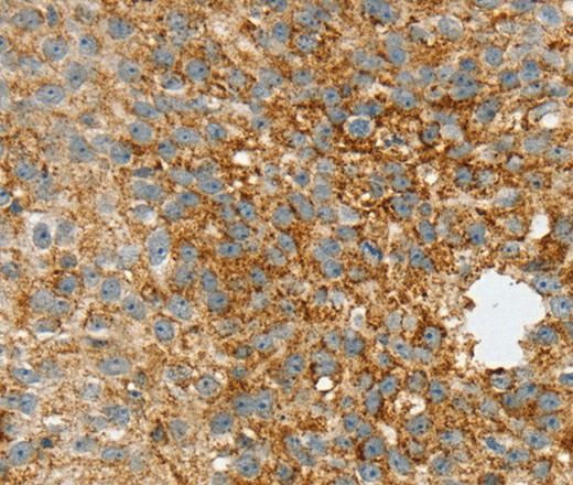 Immunohistochemistry of paraffin-embedded Human breast cancer tissue using SPARCL1 Polyclonal Antibody at dilution 1:30