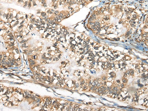 Immunohistochemistry of paraffin-embedded Human gastric cancer tissue  using BLNK Polyclonal Antibody at dilution of 1:65(?200)