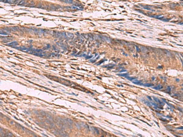 Immunohistochemistry of paraffin-embedded Human colorectal cancer tissue  using KCNN2 Polyclonal Antibody at dilution of 1:65(?200)