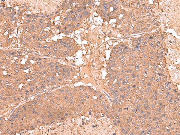 Immunohistochemistry of paraffin-embedded Human liver cancer tissue  using AHCYL1 Polyclonal Antibody at dilution of 1:65(?200)