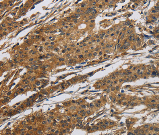 Immunohistochemistry of paraffin-embedded Human gastric cancer tissue using Claudin 2 Polyclonal Antibody at dilution 1:50