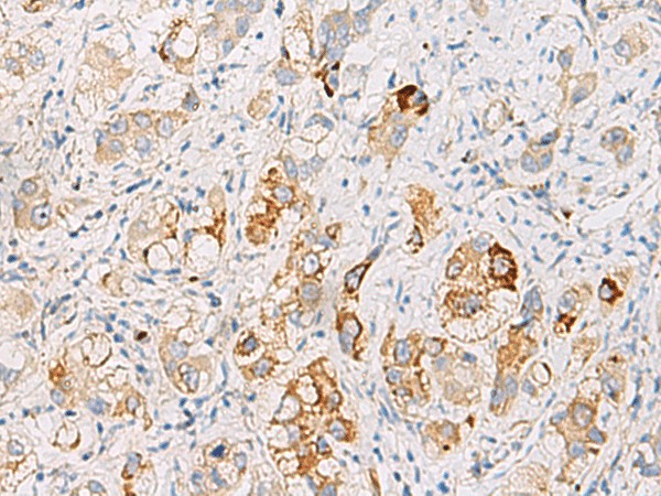 Immunohistochemistry of paraffin-embedded Human liver cancer tissue  using DHRS2 Polyclonal Antibody at dilution of 1:50(?200)