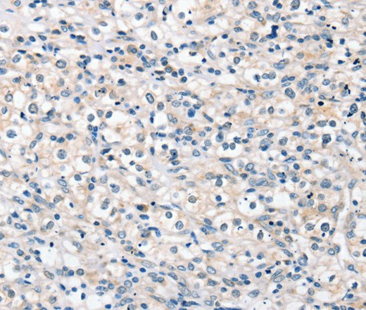 Immunohistochemistry of paraffin-embedded Human prostate cancer tissue using ROR1 Polyclonal Antibody at dilution 1:35