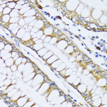 Immunohistochemistry of paraffin-embedded Human colon carcinoma using ALOX12 Polyclonal Antibody at dilution of  1:100 (40x lens).