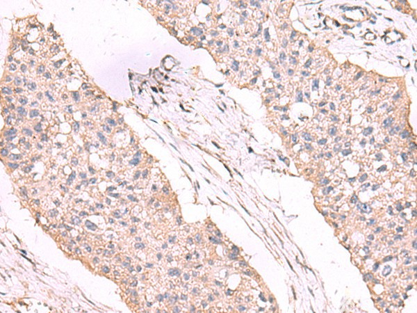 Immunohistochemistry of paraffin-embedded Human esophagus cancer tissue  using ESM1 Polyclonal Antibody at dilution of 1:55(?200)