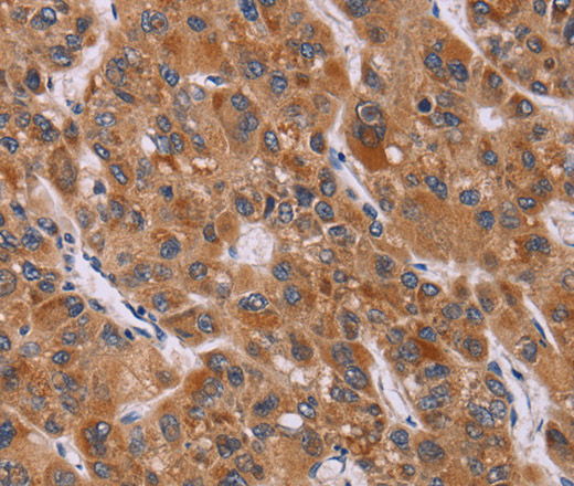 Immunohistochemistry of paraffin-embedded Human liver cancer tissue using CALCA Polyclonal Antibody at dilution 1:40