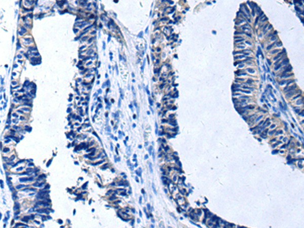 Immunohistochemistry of paraffin-embedded Human prost at e cancer tissue  using PROC Polyclonal Antibody at dilution of 1:80(?200)