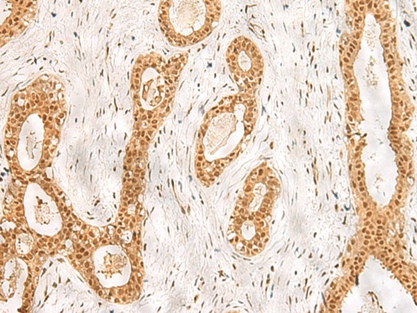 Immunohistochemistry of paraffin-embedded Human breast cancer tissue  using RPS27A Polyclonal Antibody at dilution of 1:40(?200)